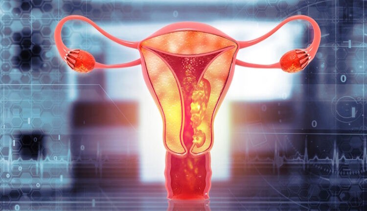 раку матки у літніх жінок